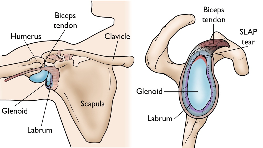 Can Playing Darts Cause Shoulder Pain