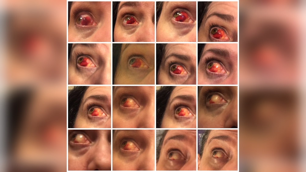 What Happens If a Dart Hits Your Eye